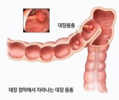 <강북구 메트로내과> [건강칼럼] 한번 생긴 대장용종, 제거 후에도 쉽게 재발한다?