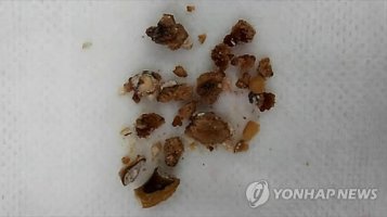 요로 결석의 초기 증상을 치료하는 방법 잘 먹기