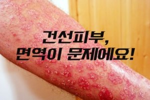 근질근질 피부건조증, 건선피부?