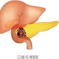 췌장을 살리는 기술