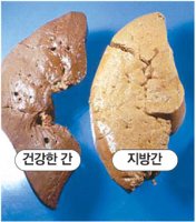 술 입에도 안대는데 웬 지방간?