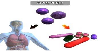 쇠그렌증후군(건조증후군) 원인 임상증상 치료 등에 관한 상식