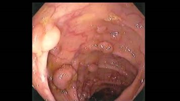 대장암의 씨앗 대장용종의 정체?