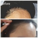 몽드랩 셀띠크30  삼성 | 강남 탈모개선 + 망한 두피 문신 복구 (전/후)o [몽드랩 셀띠끄 30]