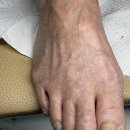 엔피(NP) 운동교육원 | 안양발톱무좀 변색되고 두꺼운 발톱 원스톱 케어 후기