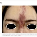 삼한사우나 | 부산이마필러 부작용, 필러가 흘러내릴 수 있을까? 울퉁불퉁함과 두통의 원인