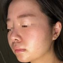 구원메디 | 메디테라피 아하 바하 롱롱 패드, 얼굴 여드름 착색 흔적 1주 사용후기