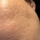 허성한의원 | 노원여드름흉터 희망이 보인다