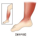 봉와직염[Cellulitis]피부질환 이미지