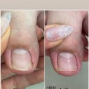 부산광역시 북구 견인보관소 | 부산 북구 화명동 내성발톱 관리 | 중2학년의 파고드는발톱, 견인 없이 관리하는 방법은?