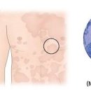 피부질환 피부 곰팡이균 어루러기 원인 증상 치료 예방 이미지