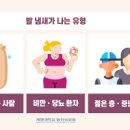 발냄새 원인 무좀 원인 증상 진단 발냄새 없애는법 이미지