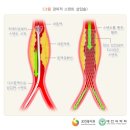 대동맥류(aortic aneurysm) 이미지