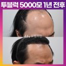 [40대 남자 헤어라인, 앞정수리 대량모발이식] 비절개 투블럭 5000모 1년 후기 (모엠의원/C자탈모/전지훈원장) 이미지