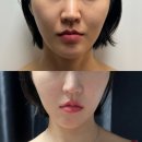 엑소바이옴텐노가와 | 사당피부관리 이수역웨딩 키미스킨앤뷰티 1회만에 효과본 페이스핏톡스