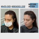 영헤어라인 이미지