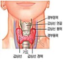 갑상선항진증 이미지