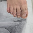 부평 무좀발톱관리 전문적인 곳에서 레푸스부평CGV점