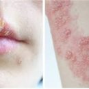 입술 수포 물집 헤르페스 대상포진 차이점과 치료법 이미지