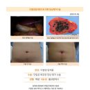 다발성담석증수술후기. 위복통으로 인해 동네의원에서 초음파검사결과 담낭제거수술을 권하시길래 병원들 알아보니 복강경 구멍 최소 3군데... 이미지