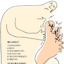 🙈🙉🙊 통풍ㆍ증상과 치료법 이미지