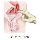 양성 전립선 비대증 Benign prostatic hyperplasia 이미지