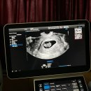 레몬산부인과의원 | 임신 초기 증상 입덧 완화 꿀템 방법- 7주 8주 9주차 임신일기