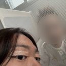 아웃라인 | [2] 부산 서면 쌍수 후기 (수술당일 ~ 14일차) 2주 후기, 절개, 인아웃라인, 쌍수 붓기, 쌍수 후기