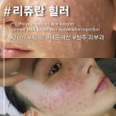 1회 사진기록전 | 청주 피부과 리쥬란 힐러 후기 | 1회차 효과, 통증, 30일 변화 솔직 기록 (내돈내산)