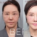 성리안미용실 | "못 알아볼 정도" 62세 유혜리, 안면거상+지방재배치 2주 후 달라진 외모