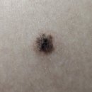 연세영피부과의원 | 흑색종의심으로 강북삼성병원 조직검사 받은 후기