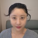 5361 | 경기광주두피 경기광주탈모커버 다다쁨 SMP 헤어라인 후기