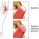 내측상과염 (Golf Elbow) 이미지