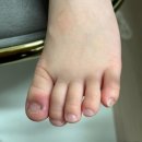 세븐일레븐 평택고덕스카이점 | 평택고덕스카이정형외과 아이 내성발톱 치료 항생제,포비돈 발라주기