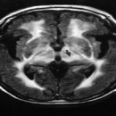 Haw River 증후군 Dentatorubro-Pallidoluysian atrophy(DRPLA) 이미지