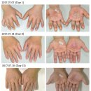 원일한의원 | [논문case] 한포진으로 진단된 소양인 환자 치험 1례