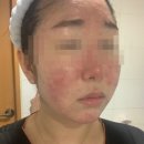 거창한의원 | 주사피부염 한의원에서 잘 맞았던 치료 후기