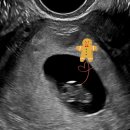 이대1번약국 | [공지] 서울역차병원 시험관 졸업 후기! 7주차 초음파와 증상기록