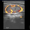 Thyroid adenoma 이미지