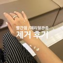 군산 :: 혈관종 / 빨간반점 (체리혈관종) 뺀 후기 [피부과&amp;레이저 이름 알려드림]