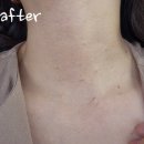 나디연세외과의원 | 수술 제거 후기 2017년 1차 수술/2025년 2차 수술/ 수술전후 사진(나디연세외과의원-내돈내산실비보험)