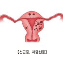 원발성 월경곤란[Primary dysmenorrhea]여성질환 이미지
