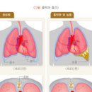 오른쪽 왼쪽 폐 통증 원인 및 치료 : 코로나 이미지