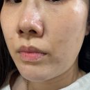 콜 | 청담피부과 PRP주사 스킨부스터+울트라콜 셀트라콜 후기, 효과