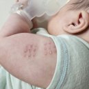 성애어린이집 | bcg 경피용 고름 터짐 후 흉터 관리 언제까지