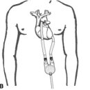 Single-center experience with treatment of cardiogenic shock in children by pediatric ventricular assist devices 이미지