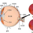 안압이 높을때 나타나는 증상과 ★ &#39;안압&#39;을 낮추는 방법 이미지