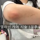 메디레이 | 대구 피부관리,대구 미백 색소침착 관리 플라즈마 후기 "대구 플라즈마 모드에스테틱"