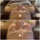 장유 무계지하차도 | 김해 율하 리프팅관리 골드테라피 피부관리 3회차 온다웨이브+써마튠