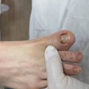 레푸스 감삼점&에이레네 | 이 고민 끝! 레푸스감삼점&amp;에이레네, 대구내성발톱 해결 필수 방문